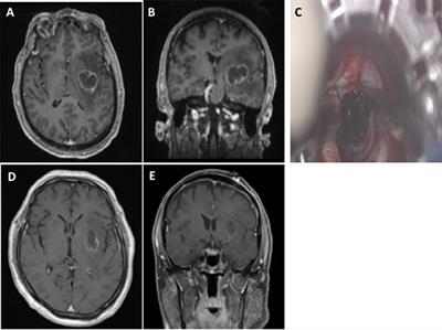 Frontiers Contemporary Surgical Management of Deep Seated